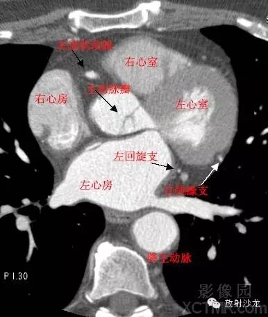 心脏冠状动脉CT解剖中文详细标注