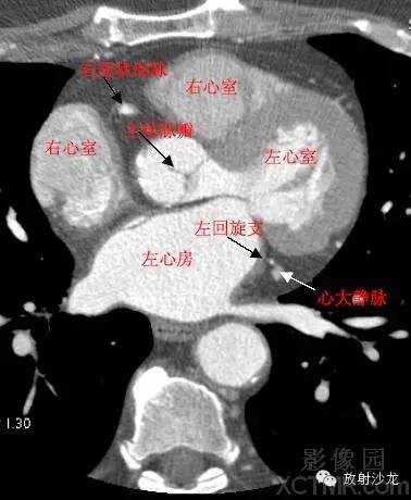 心脏冠状动脉CT解剖中文详细标注