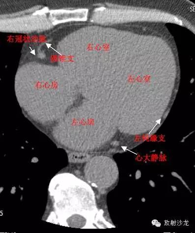 心脏冠状动脉CT解剖中文详细标注