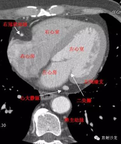 心脏冠状动脉CT解剖中文详细标注