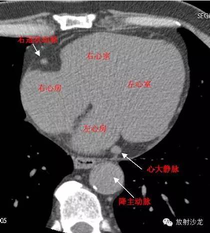 心脏冠状动脉CT解剖中文详细标注