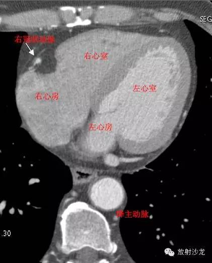 心脏冠状动脉CT解剖中文详细标注