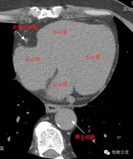 心脏冠状动脉CT解剖中文详细标注