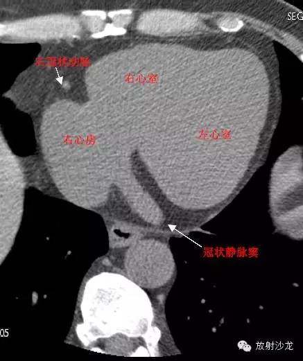 心脏冠状动脉CT解剖中文详细标注