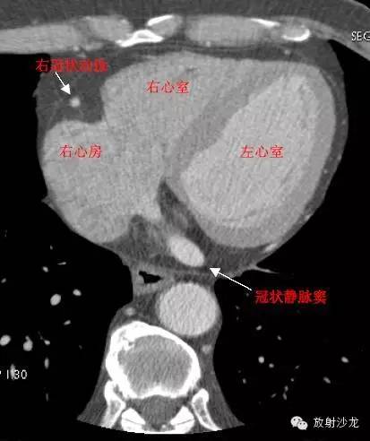 心脏冠状动脉CT解剖中文详细标注