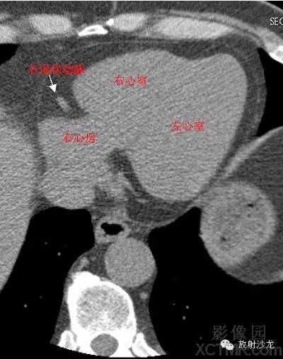 心脏冠状动脉CT解剖中文详细标注