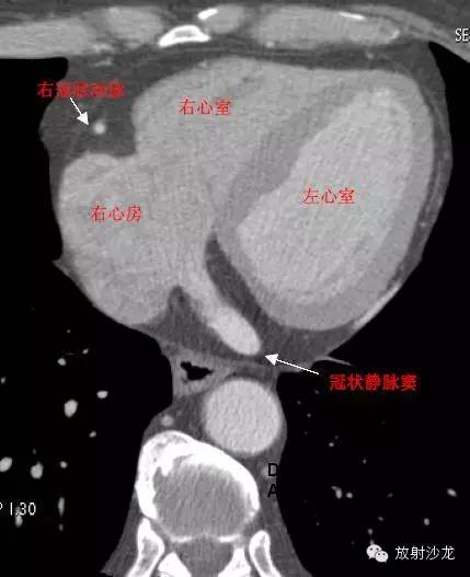 心脏冠状动脉CT解剖中文详细标注