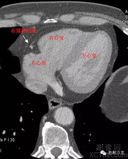 心脏冠状动脉CT解剖中文详细标注