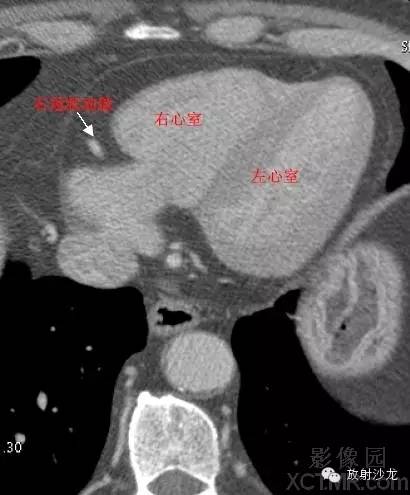 心脏冠状动脉CT解剖中文详细标注