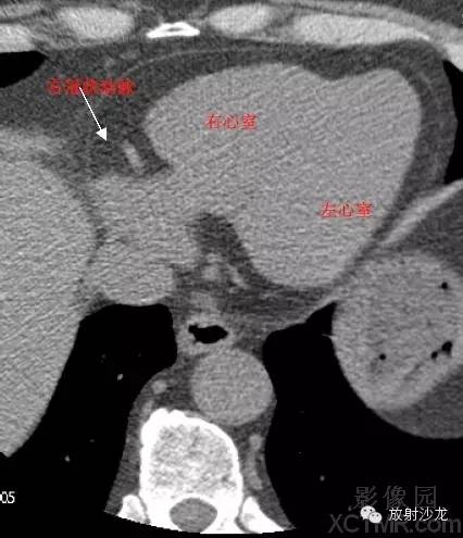 心脏冠状动脉CT解剖中文详细标注