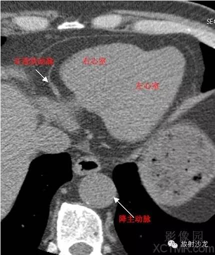 心脏冠状动脉CT解剖中文详细标注