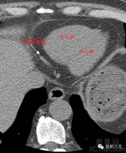 心脏冠状动脉CT解剖中文详细标注