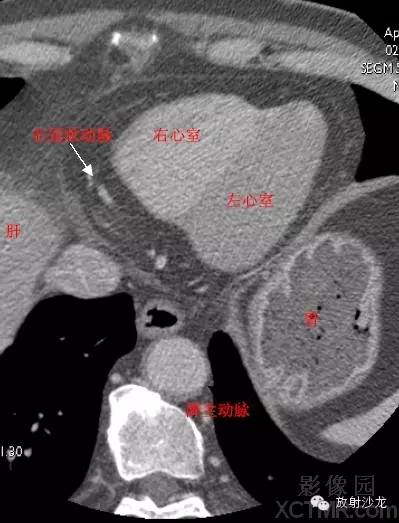 心脏冠状动脉CT解剖中文详细标注