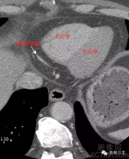 心脏冠状动脉CT解剖中文详细标注