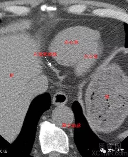 心脏冠状动脉CT解剖中文详细标注