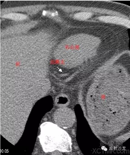 心脏冠状动脉CT解剖中文详细标注