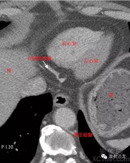 心脏冠状动脉CT解剖中文详细标注