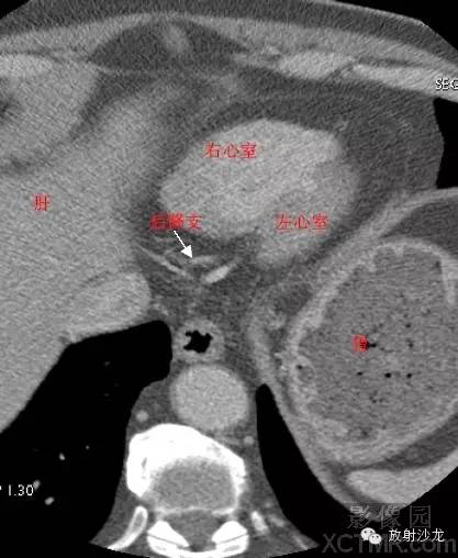 心脏冠状动脉CT解剖中文详细标注