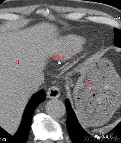 心脏冠状动脉CT解剖中文详细标注