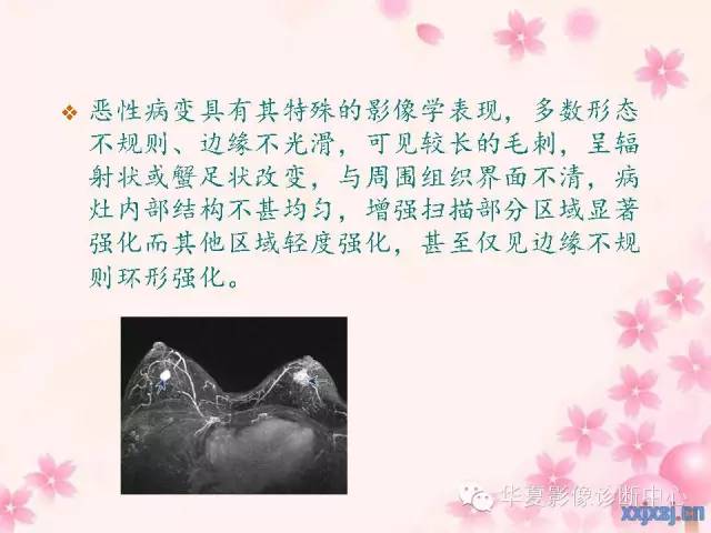 【PPT】乳腺MRI对直径1厘米左右小结节灶良恶性的界定作用