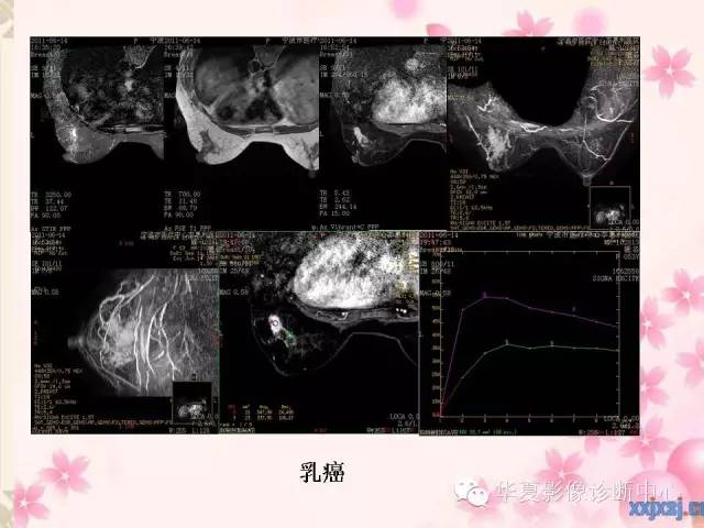 【PPT】乳腺MRI对直径1厘米左右小结节灶良恶性的界定作用