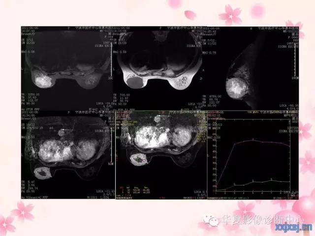 【PPT】乳腺MRI对直径1厘米左右小结节灶良恶性的界定作用