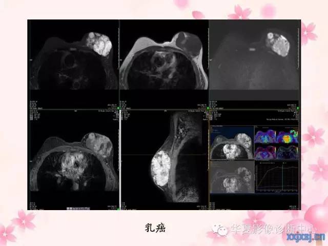 【PPT】乳腺MRI对直径1厘米左右小结节灶良恶性的界定作用