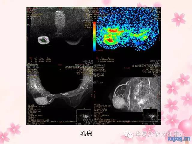 【PPT】乳腺MRI对直径1厘米左右小结节灶良恶性的界定作用
