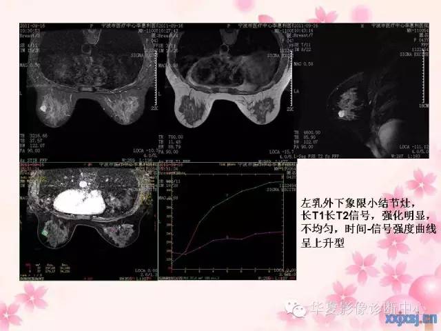 【PPT】乳腺MRI对直径1厘米左右小结节灶良恶性的界定作用