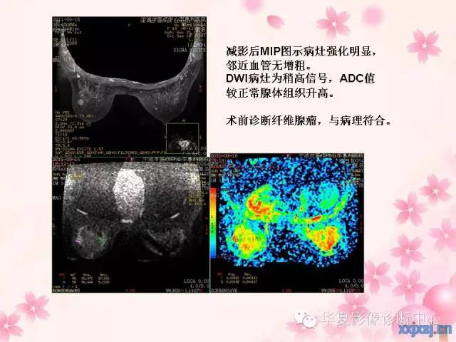 【PPT】乳腺MRI对直径1厘米左右小结节灶良恶性的界定作用