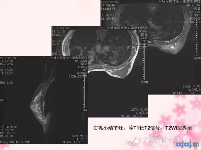 【PPT】乳腺MRI对直径1厘米左右小结节灶良恶性的界定作用