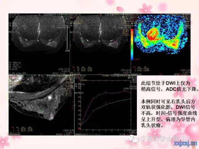 【PPT】乳腺MRI对直径1厘米左右小结节灶良恶性的界定作用