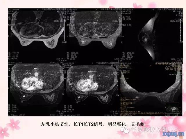 【PPT】乳腺MRI对直径1厘米左右小结节灶良恶性的界定作用