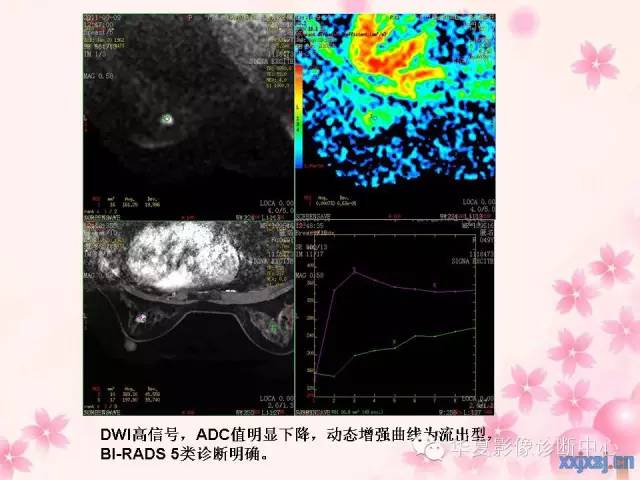 【PPT】乳腺MRI对直径1厘米左右小结节灶良恶性的界定作用
