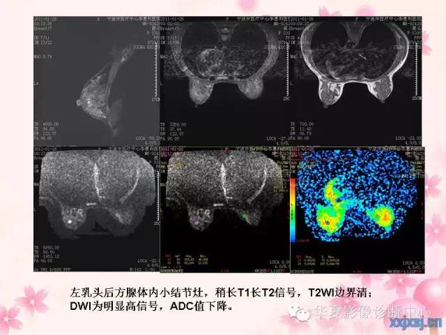 【PPT】乳腺MRI对直径1厘米左右小结节灶良恶性的界定作用