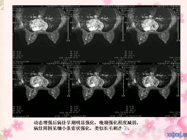 【PPT】乳腺MRI对直径1厘米左右小结节灶良恶性的界定作用