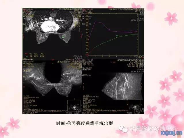 【PPT】乳腺MRI对直径1厘米左右小结节灶良恶性的界定作用