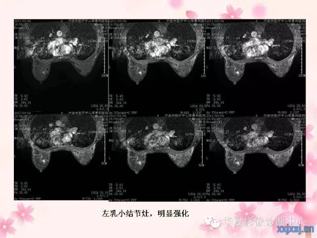 【PPT】乳腺MRI对直径1厘米左右小结节灶良恶性的界定作用