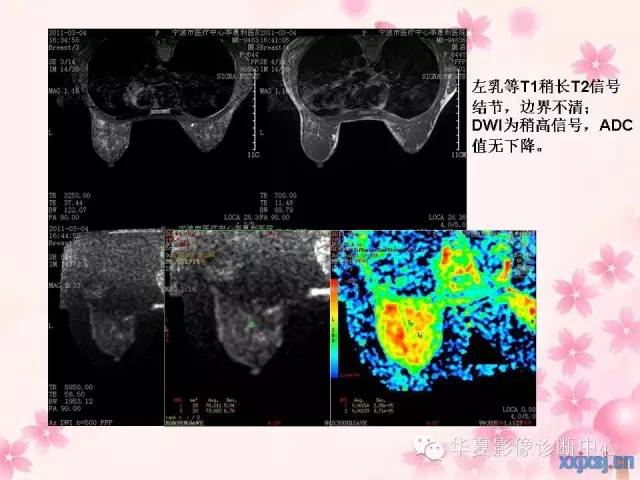 【PPT】乳腺MRI对直径1厘米左右小结节灶良恶性的界定作用
