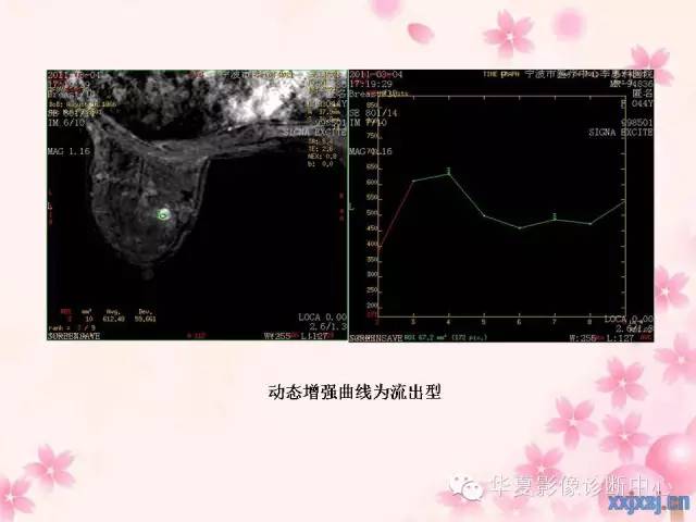 【PPT】乳腺MRI对直径1厘米左右小结节灶良恶性的界定作用