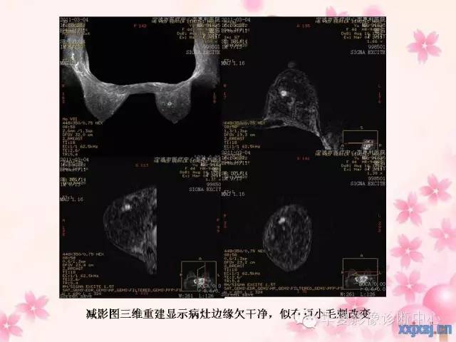 【PPT】乳腺MRI对直径1厘米左右小结节灶良恶性的界定作用