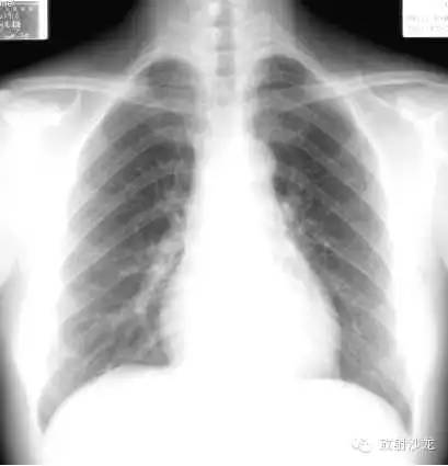 心脏常见疾病的X线诊断