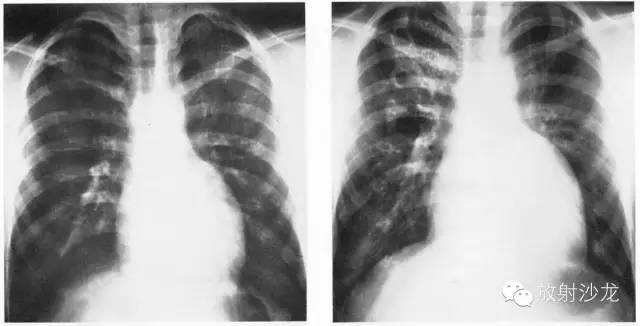 心脏常见疾病的X线诊断