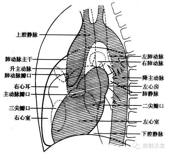 心脏常见疾病的X线诊断