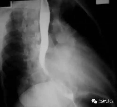 心脏常见疾病的X线诊断