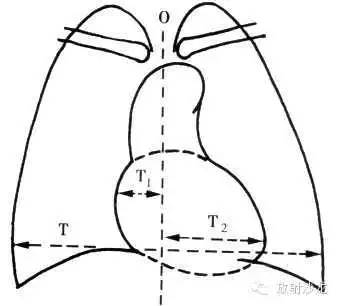 心脏常见疾病的X线诊断