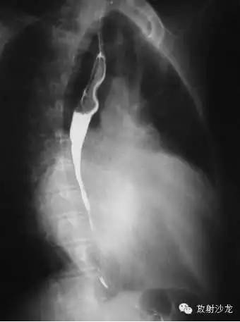 心脏常见疾病的X线诊断