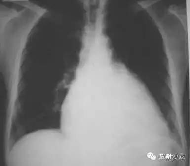 心脏常见疾病的X线诊断