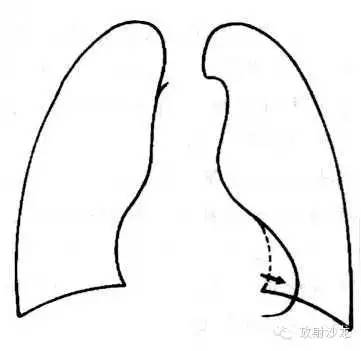 心脏常见疾病的X线诊断