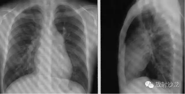心脏常见疾病的X线诊断
